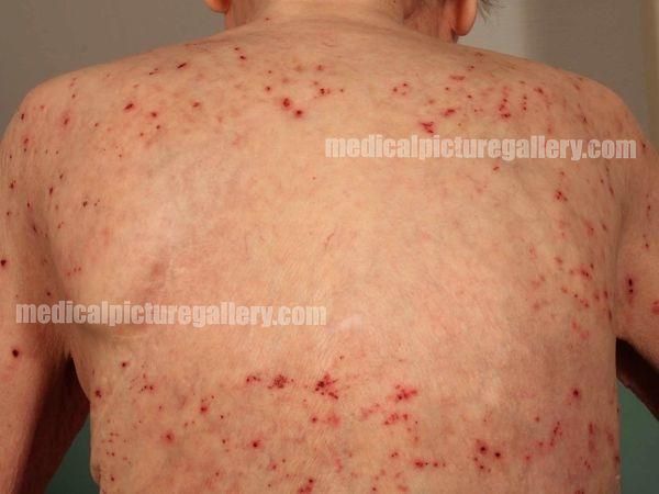 Excoriation