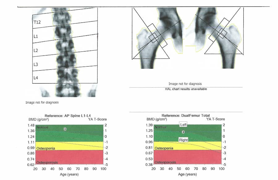 DEXA scan showing bone mineral density measurement for osteoporosis screening during menopause